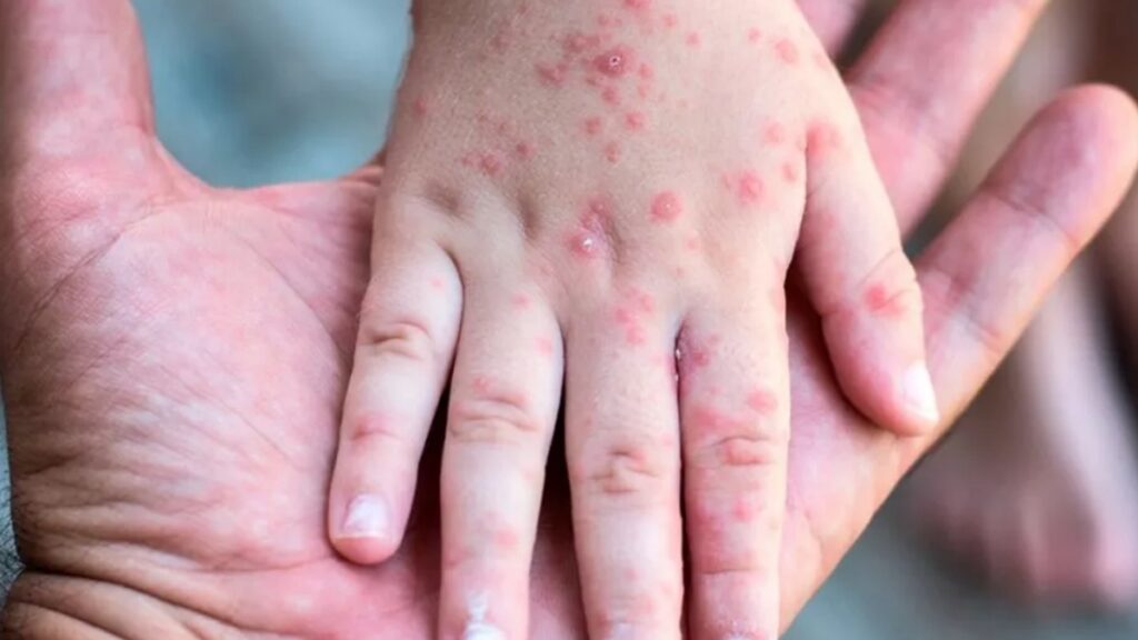 Siguen los contagios de sarampión en México