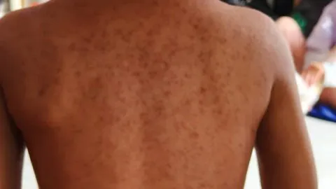 CDMX informa sobre alcaldías con más casos de sarampión y llama a no “estigmatizar”