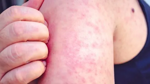 ¡Rompe el techo! México supera los 10 mil casos de sarampión, suma 31 defunciones