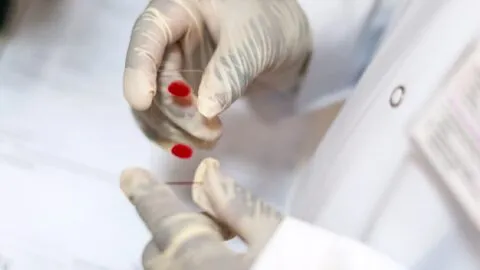 Sin cita y gratis: pruebas rápidas de VIH, hepatitis C y sífilis en CDMX; sede y horarios