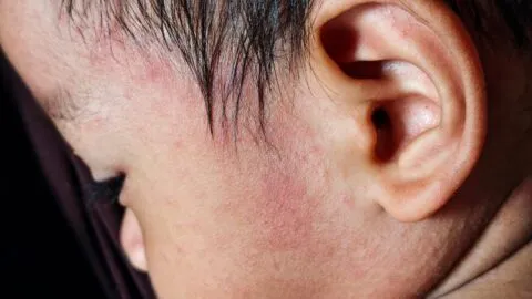 Las graves secuelas que puede dejar el sarampión: encefalitis y sordera permanente
