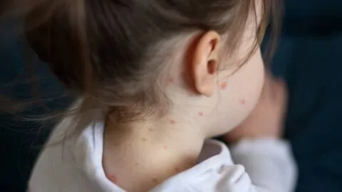 Cerco sanitario por sarampión: ¿qué se sabe del primer caso en niña de Baja California Sur?