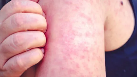 OPS alerta por aumento de sarampión en el continente americano ante la cercanía del Mundial 2026