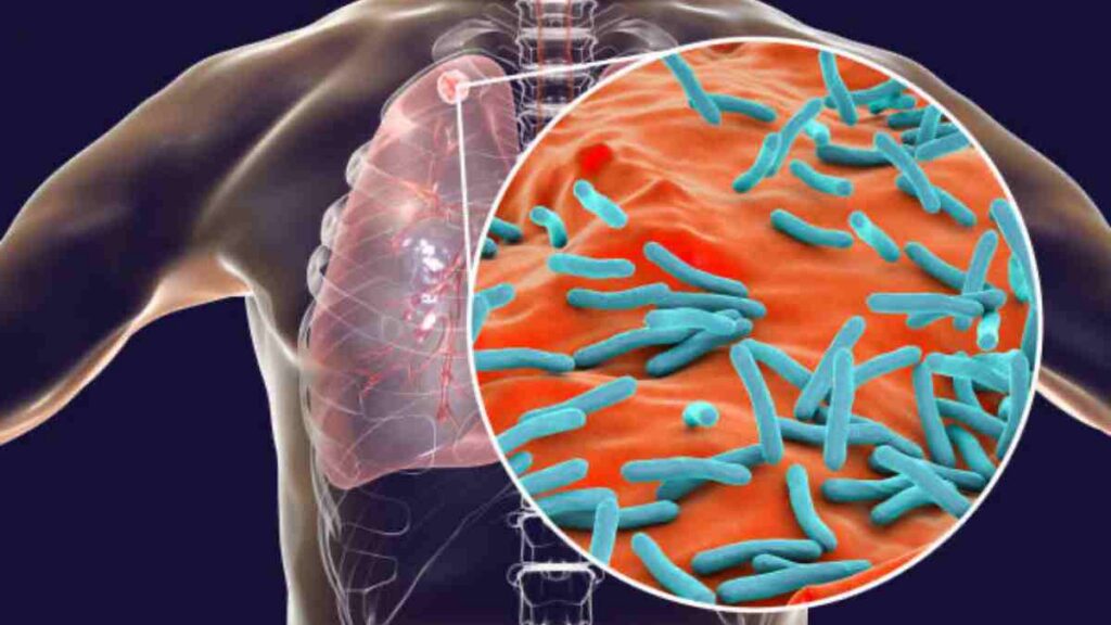 Veracruz tiene 135 casos de tuberculosis