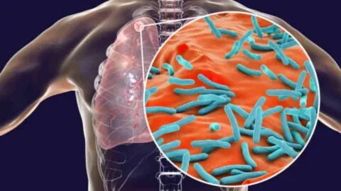 No sólo es sarampión: suben casos de tuberculosis respiratoria en 2026, ve señales de alerta