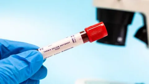 UNAM advierte sobre riesgos de Taenia solium y cisticercosis ante alerta de la OMS