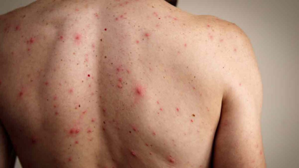 México busca detener al sarampión