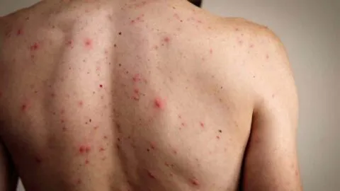 ¿Por qué los mayores de 50 años no se tienen que vacunar contra el sarampión?