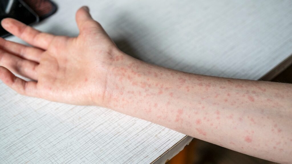 Sinaloa tiene su primera muerte por sarampión