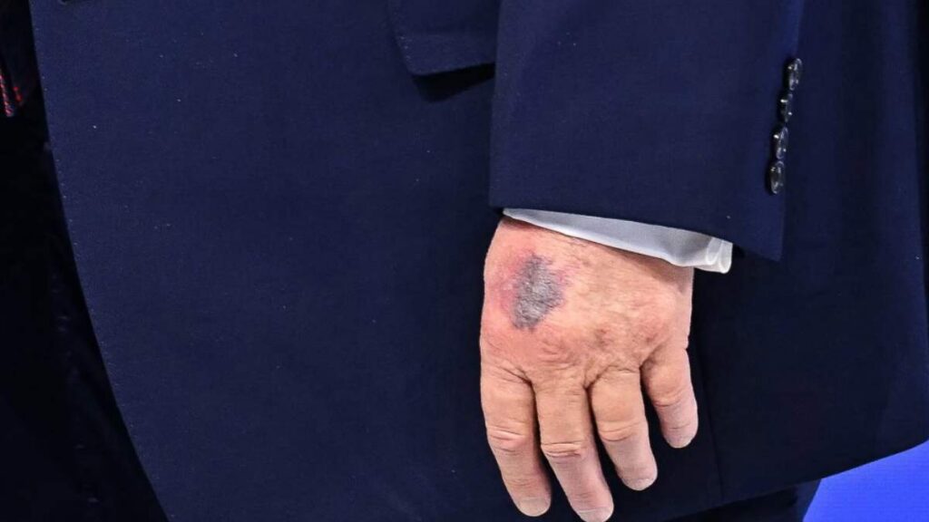 Trump lució moretones en su mano durante el Foro.