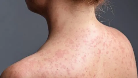 Sinaloa confirma primera muerte por sarampión; van 34 en México