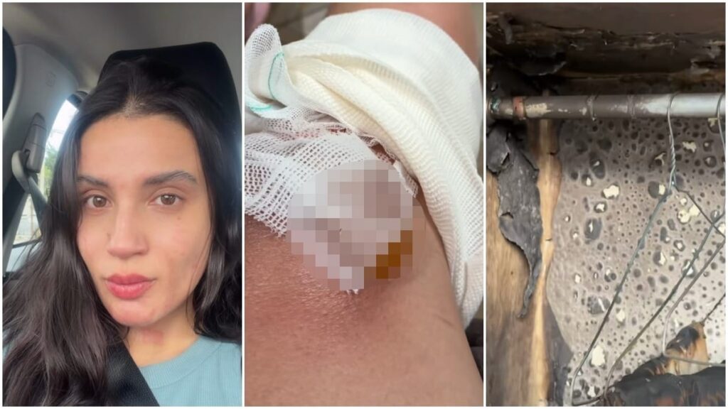 Patricia Valenzuela se recupera de sus quemaduras