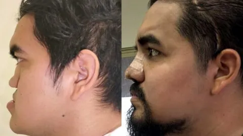 Especialistas del IMSS reconstruyen rostro de un joven tras 25 años de afecciones congénitas