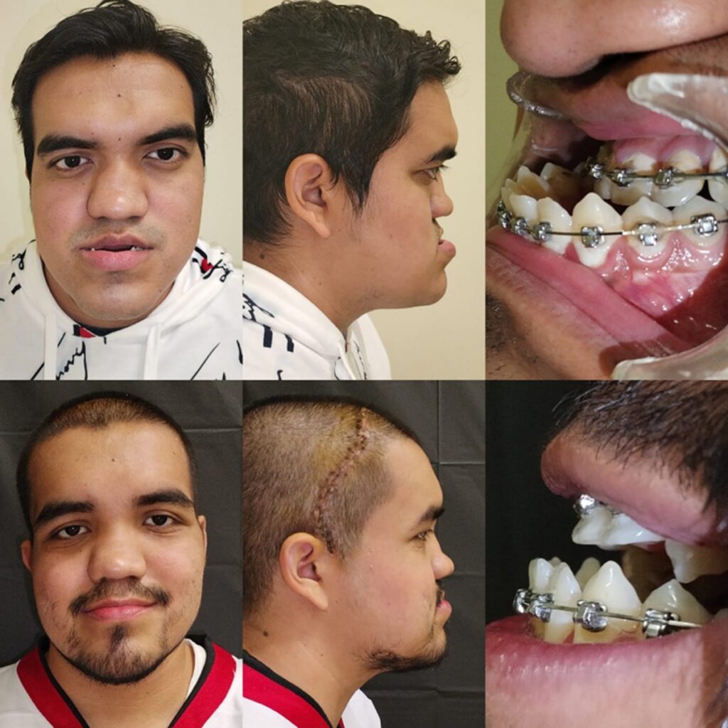 Ángel Abraham recuperó la respiración, masticación y su calidad de vida mediante una reconstrucción facial integral realizada por especialistas del Seguro Social en Nuevo León.