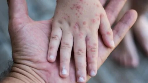 Esta es la factura millonaria que genera el sarampión en Estados Unidos