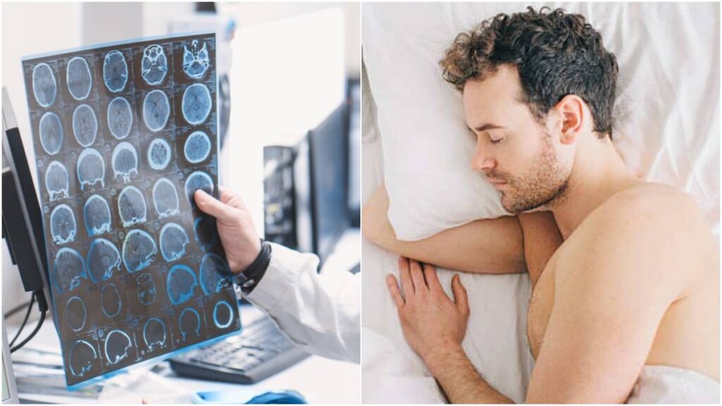 Microdespertares se relacionan con riesgo genético de Alzheimer