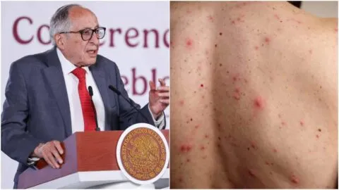 México en riesgo de perder certificación como país libre de sarampión