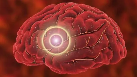 Las tasas de accidentes cerebrovasculares casi se duplican en adultos jóvenes