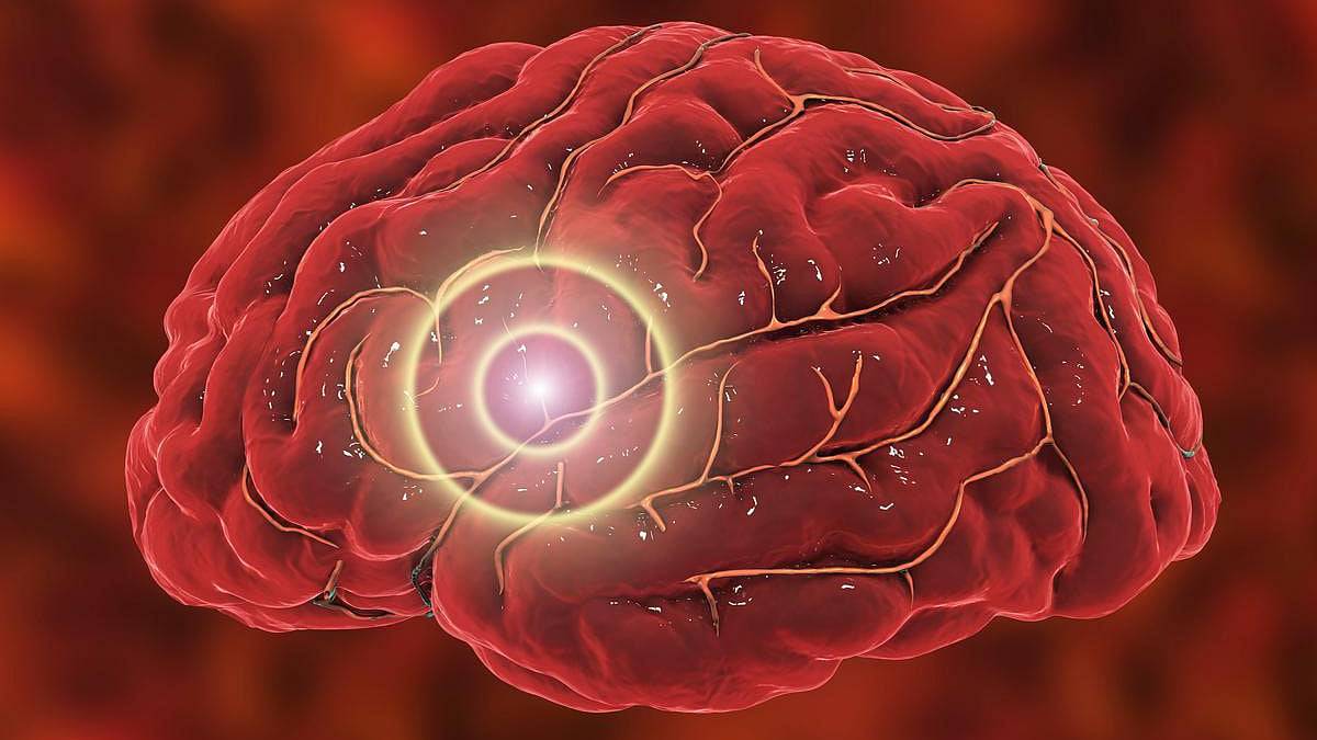 Las tasas de accidentes cerebrovasculares casi se duplican en adultos jóvenes