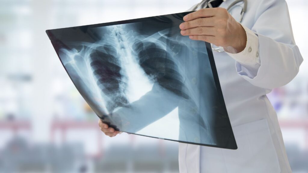 Varios casos de silicosis en California están generando daños pulmonares irreparables