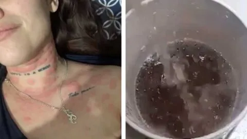 Joven denuncia daños en la piel por bañarse con agua contaminada en Jalisco