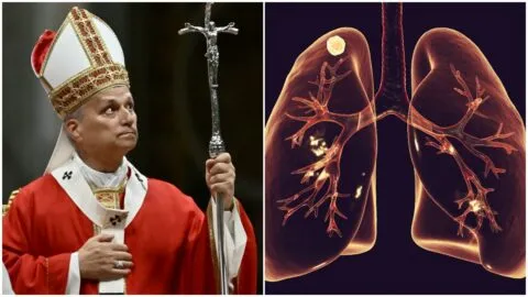 ¿Qué es un nódulo pulmonar, la afección por la que operarán al Papa León XIV?