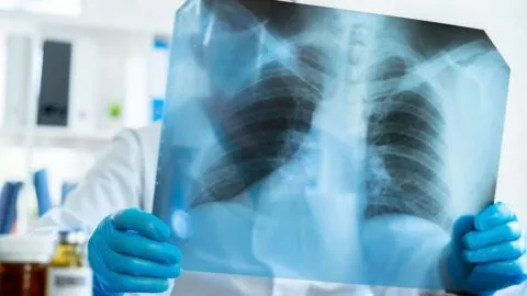 Peste neumónica: ¿por qué puede causar la muerte en 18 horas?