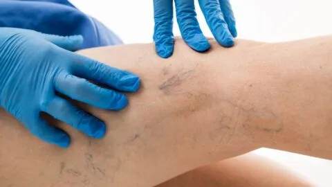 Una de cada cuatro muertes en el mundo se relaciona con la trombosis; México busca detectar casos a tiempo
