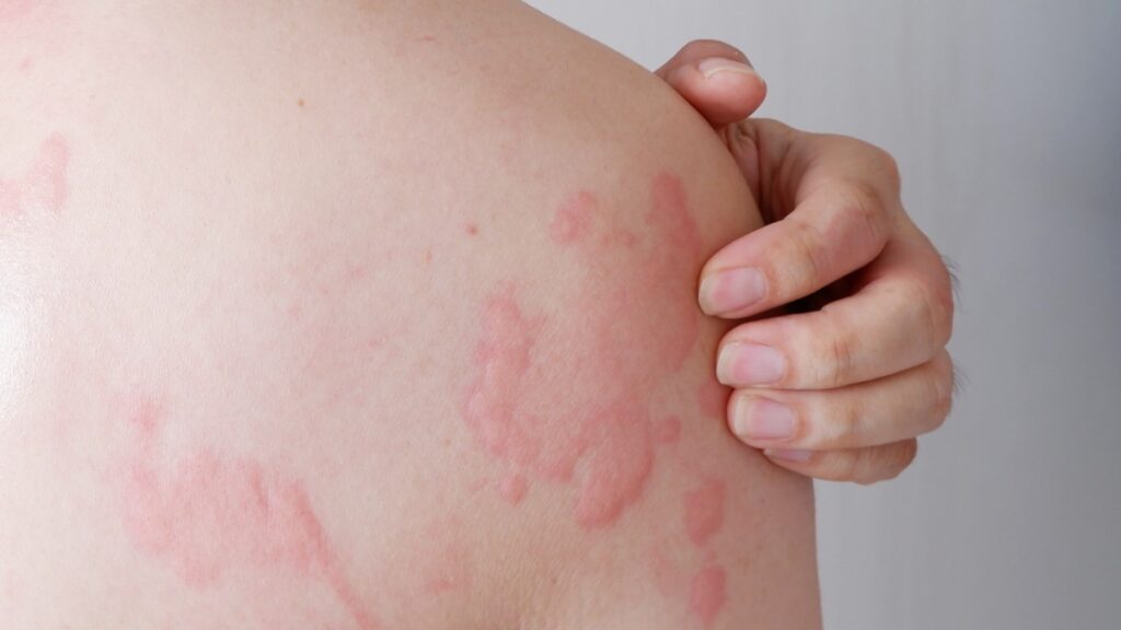 Urticaria cuando es y cuando es una roncha