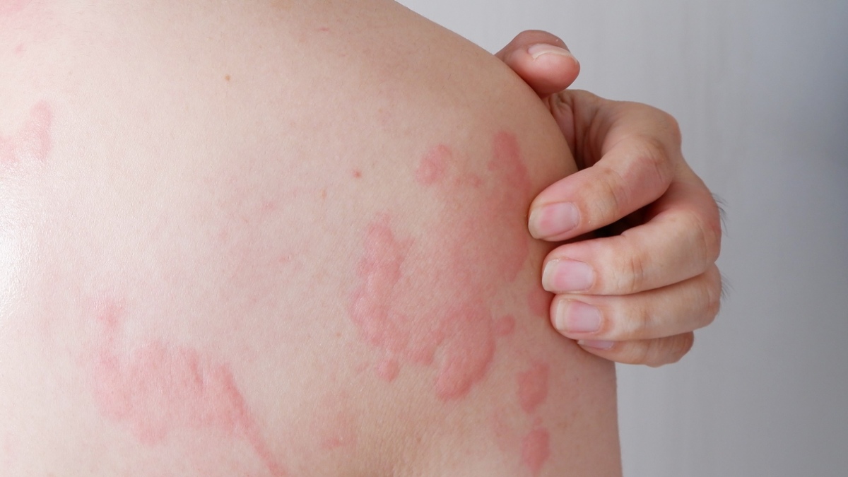 ¿Te salió una mancha? Podría no ser un piquete de insecto, sino urticaria